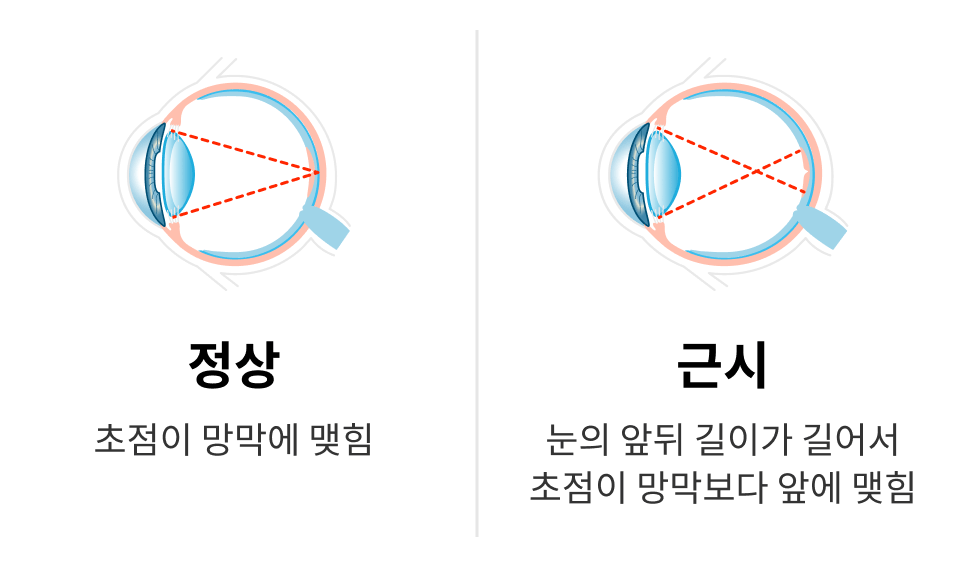 정상:초점이 망막에 맺힘, 근시:눈의 앞뒤 길이가 길어서 초점이 망막보다 앞에 맺힘